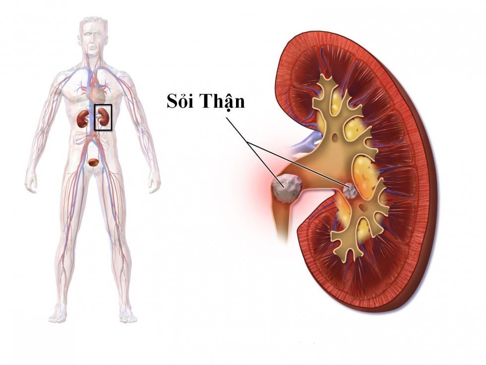 bệnh sỏi thận